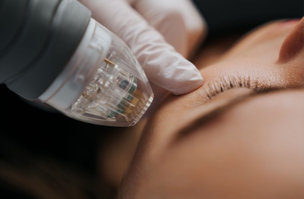 A close-up showing a handheld device near a patient's eyes during their radiofrequency session for dry eye relief.