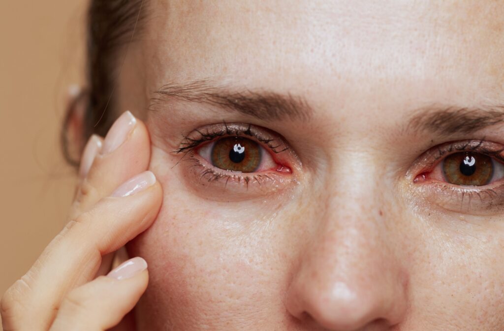 A close-up photo of a person with red, irritated eyes.
